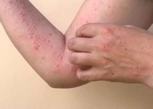 Kasus Langka Mpox Ditemukan di Riau, Dinas Kesehatan Imbau Masyarakat Waspada